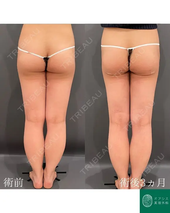 カリカリボディを目指す🌴コンプリート脂肪吸引【大腿全周臀部一部含む】形成外科専門医がご対応 after画像 メイン用