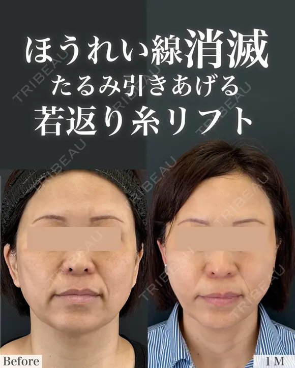脂肪吸引×糸リフト 1日後 メイン用