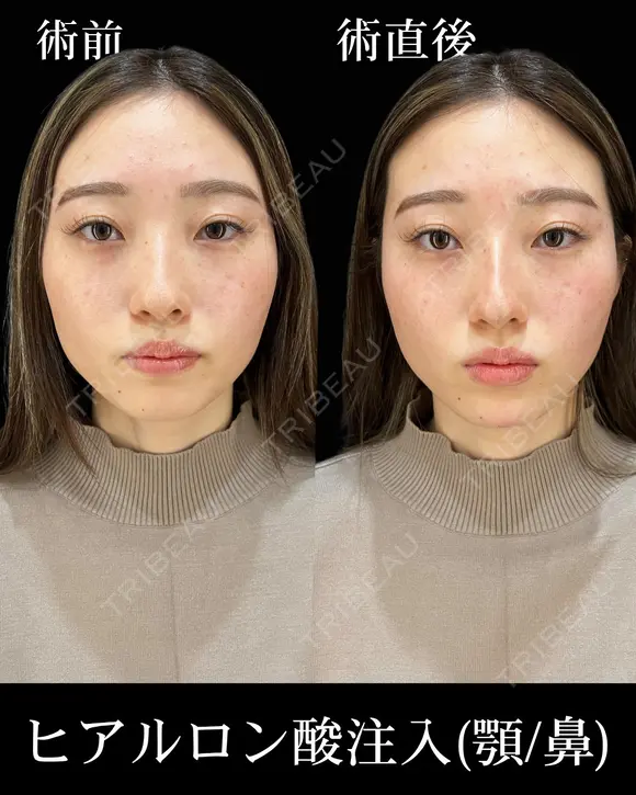 ヒアルロン酸注入 after画像 メイン用