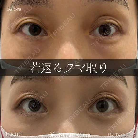 岩切医師による🔥クマ取り🔥 before画像 メイン用