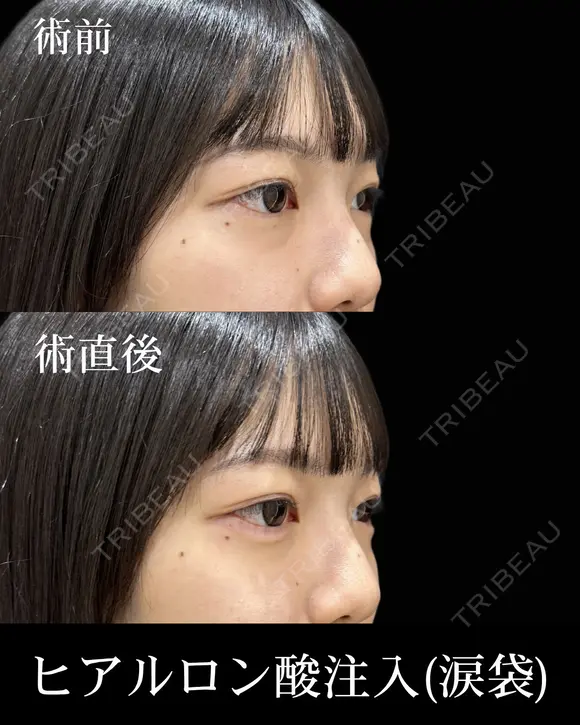 ヒアルロン酸注入 before画像 メイン用