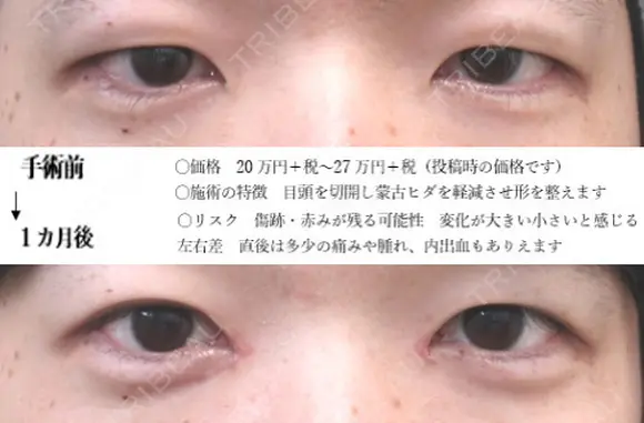 目頭切開法 before画像 メイン用