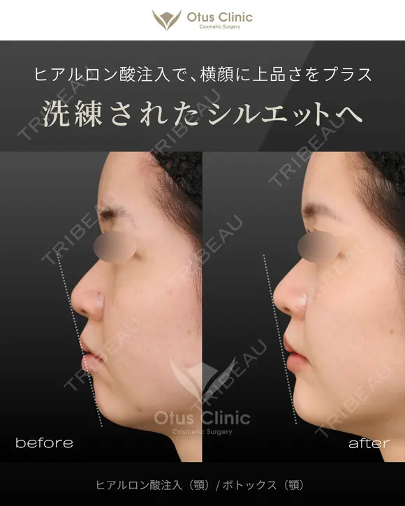 ヒアルロン酸注入（顎）・ボトックス（顎） before画像 メイン用
