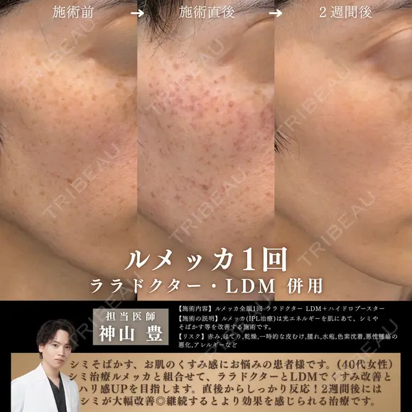 ルメッカ×ララドクター×LDM before画像 メイン用