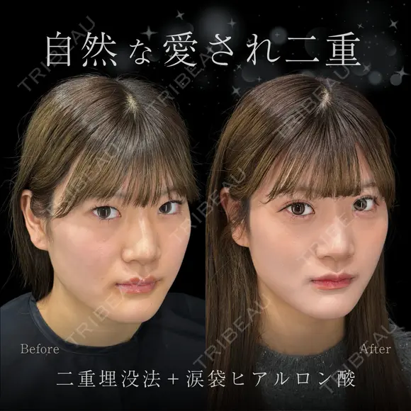 二重埋没法・涙袋ヒアルロン酸 14日後 メイン用
