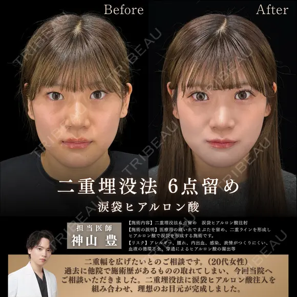 二重埋没法・涙袋ヒアルロン酸 before画像 メイン用