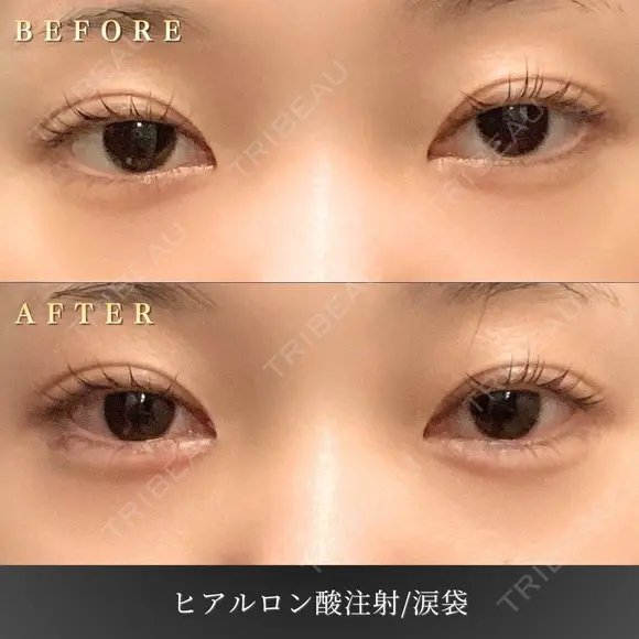 涙袋ヒアルロン酸 before画像 メイン用