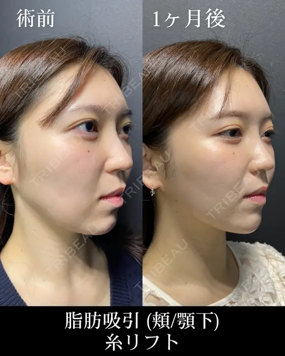 脂肪吸引 after画像 メイン用