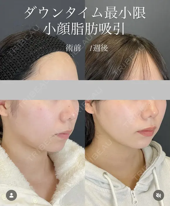 顔の脂肪吸引 before画像 メイン用