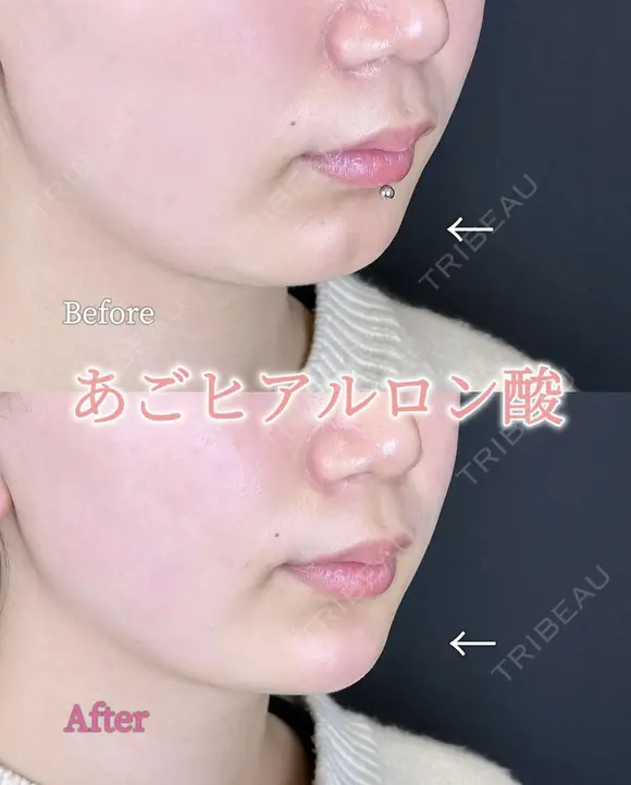 アゴのヒアルロン酸 before画像 メイン用
