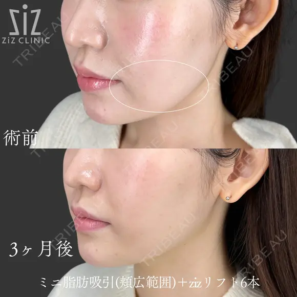 【ミニ脂肪吸引】口横ぽにょ消えた！ before画像 メイン用