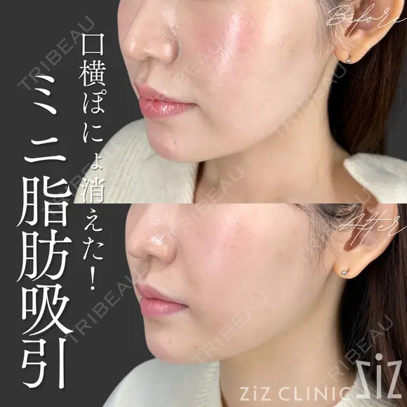 【ミニ脂肪吸引】口横ぽにょ消えた！ after画像 メイン用