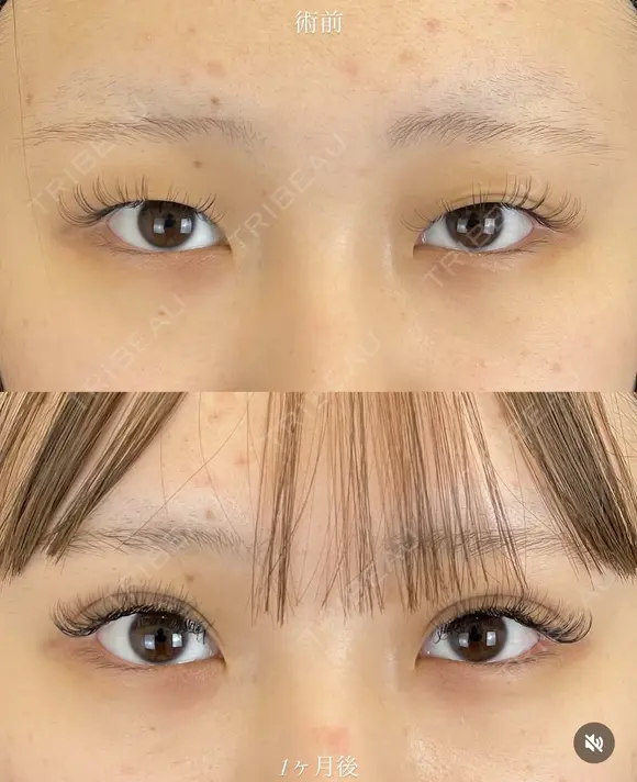 二重埋没(ルラコスメダブル） before画像 メイン用