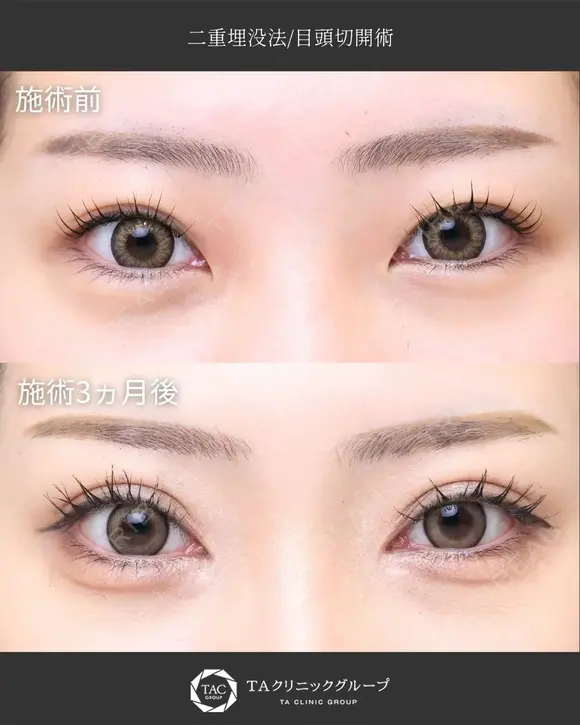 【20代女性・平行型二重】二重埋没・目頭切開 before画像 メイン用