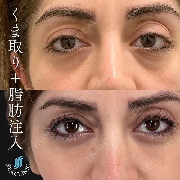 くま取り＋脂肪注入 after画像 メイン用