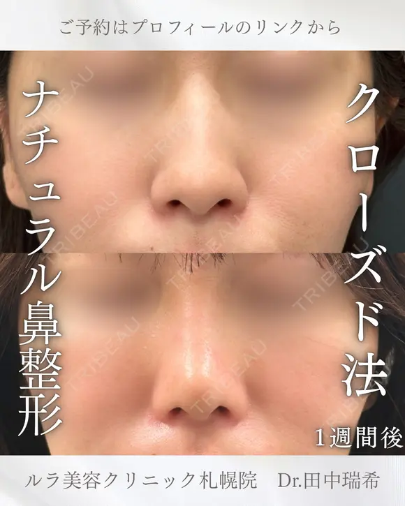 鼻尖形成耳介軟骨移植（クローズ法） before画像 メイン用