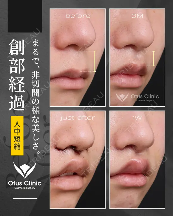 人中短縮（鼻孔内切開） before画像 メイン用