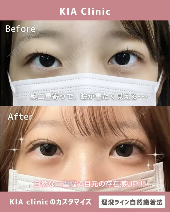 すっぴんも盛れる♡理想の二重ライン before画像 メイン用