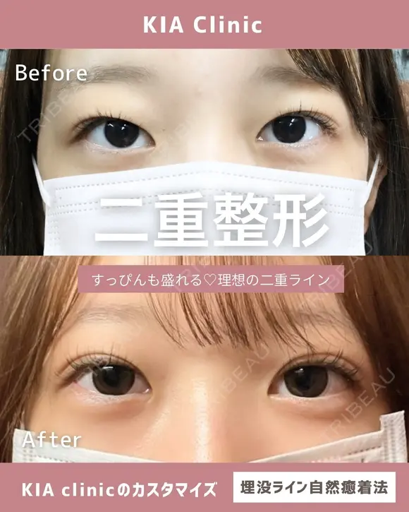 すっぴんも盛れる♡理想の二重ライン after画像 メイン用