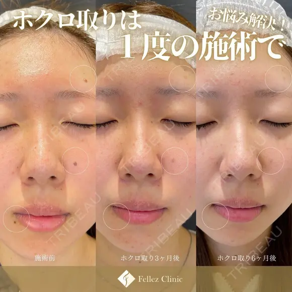 顔・身体OK！当院人気No１ホクロ治療✨年間10万個ホクロ・イボ除去Dr在籍🐰 after画像 メイン用