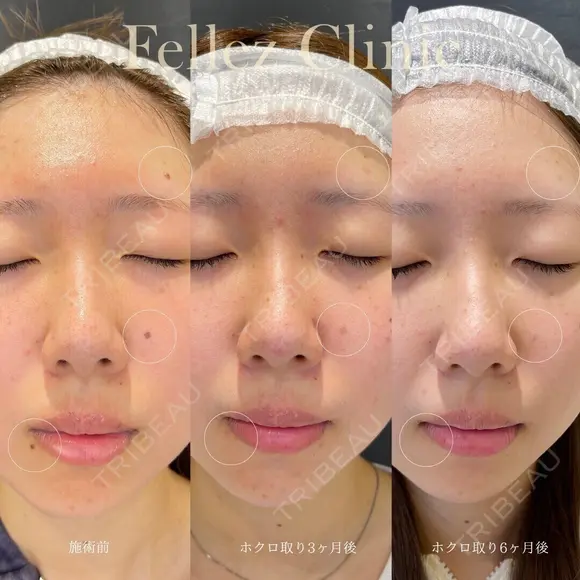 顔・身体OK！当院人気No１ホクロ治療✨年間10万個ホクロ・イボ除去Dr在籍🐰 before画像 メイン用