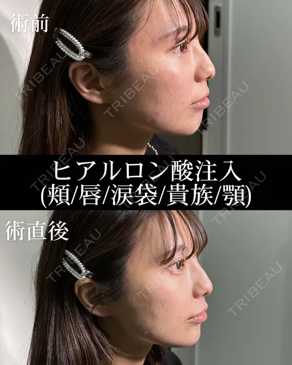 ヒアルロン酸注入（頬/唇/涙袋/貴族/顎） before画像 メイン用