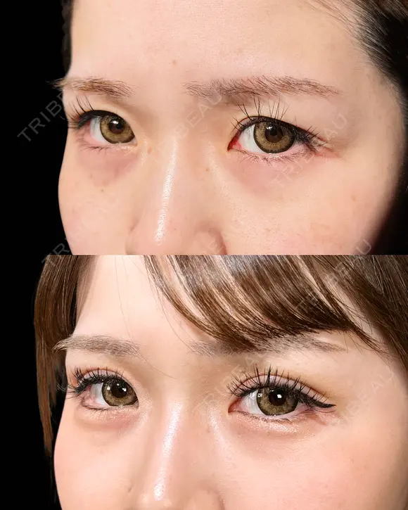 山本の二重埋没 before画像 メイン用
