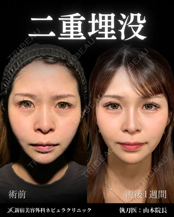 山本の二重埋没 after画像 メイン用