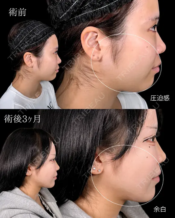 山本による🎀小顔脂肪吸引🎀 before画像 メイン用