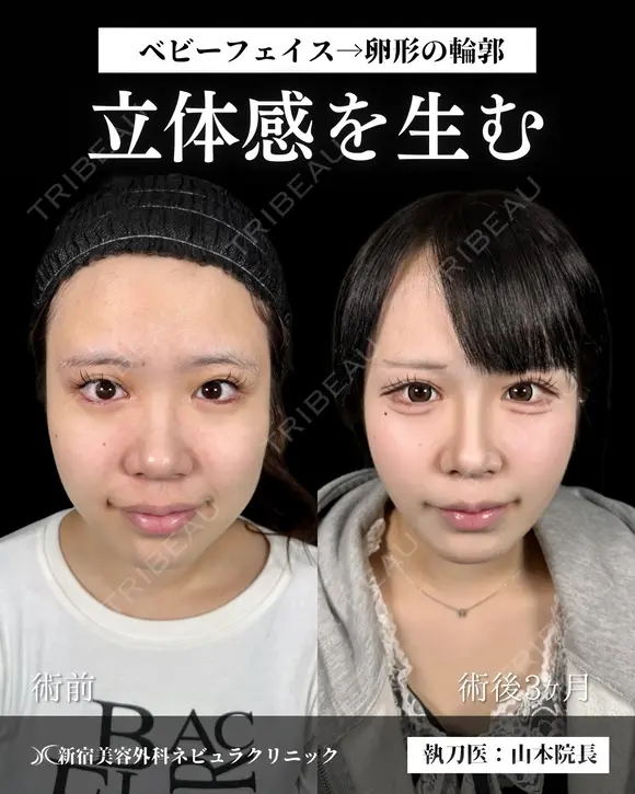 山本による🎀小顔脂肪吸引🎀 after画像 メイン用
