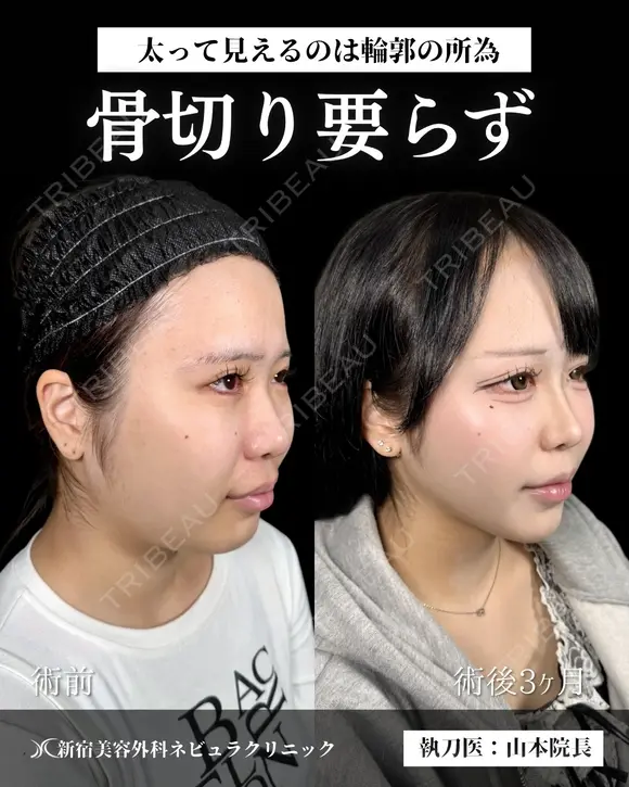 山本による🎀小顔脂肪吸引🎀 after画像 メイン用