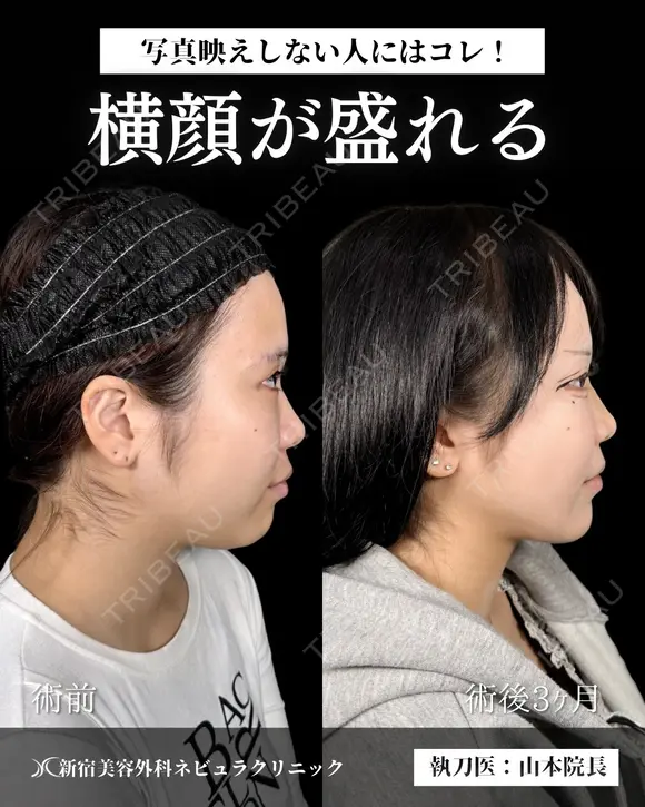 山本による🎀小顔脂肪吸引🎀 after画像 メイン用