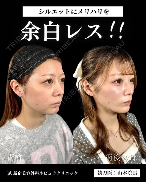 山本による🎀小顔脂肪吸引🎀 after画像 メイン用