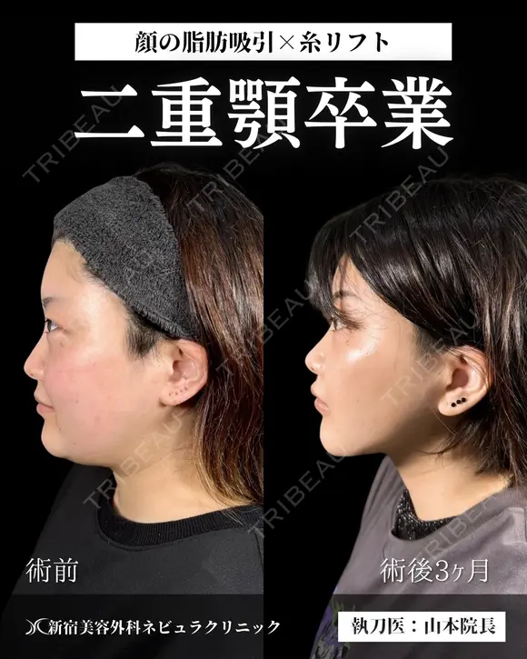 山本による🎀小顔脂肪吸引🎀 after画像 メイン用