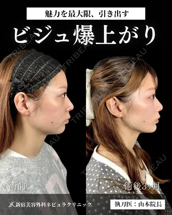 山本による🎀小顔脂肪吸引🎀 after画像 メイン用