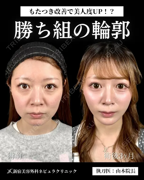 山本による🎀小顔脂肪吸引🎀 after画像 メイン用