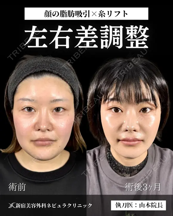 山本による🎀小顔脂肪吸引🎀 after画像 メイン用