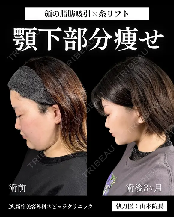 山本による🎀小顔脂肪吸引🎀 before画像 メイン用