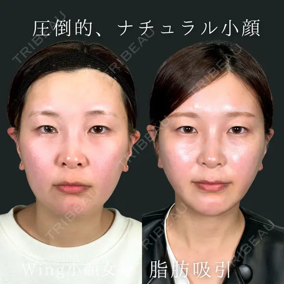 Wing小顔女神脂肪吸引 30日後 メイン用