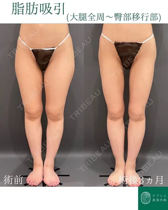 カリカリボディを目指す🌴コンプリート脂肪吸引【大腿全周臀部一部含む】形成外科専門医がご対応 after画像 メイン用