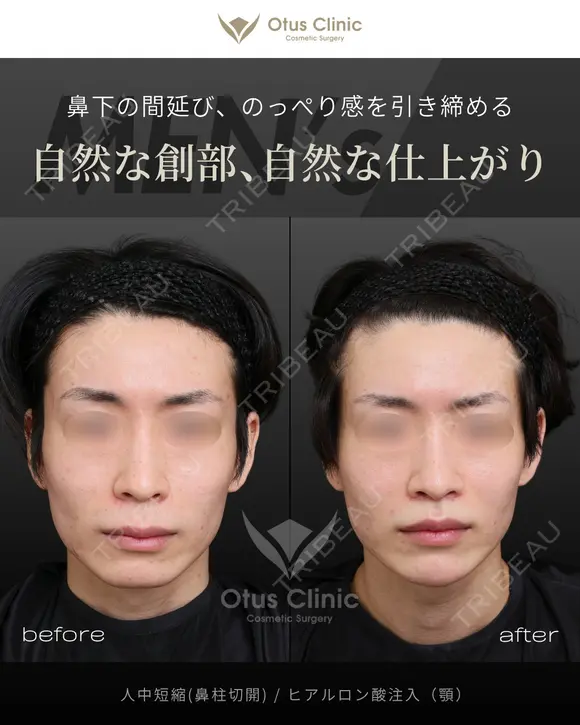 鼻柱切開人中短縮・ヒアルロン酸注入（顎） before画像 メイン用