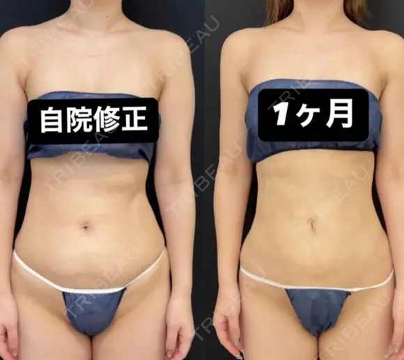シークレット脂肪吸引自院修正 30日後 メイン用
