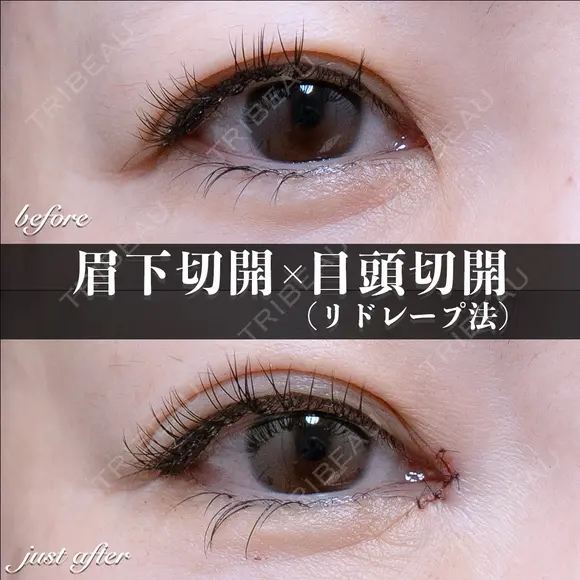 目頭切開(リドレープ法)･眉下切開 before画像 メイン用