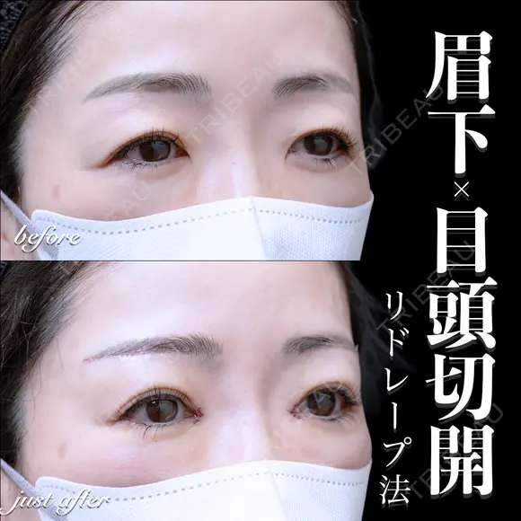 目頭切開(リドレープ法)･眉下切開 0日後 メイン用