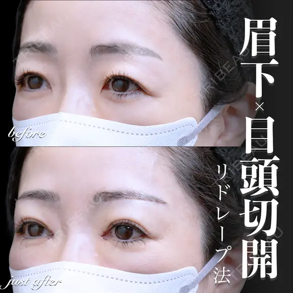 目頭切開(リドレープ法)･眉下切開 0日後 メイン用