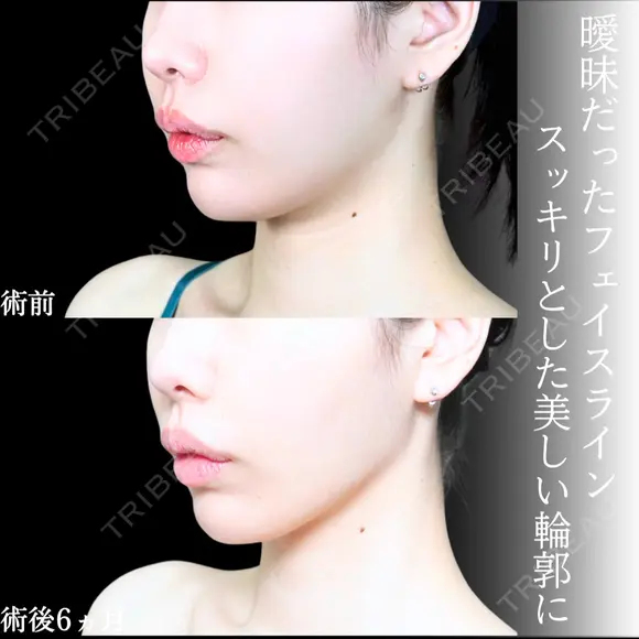 頬・あご下脂肪吸引 /糸リフト/ジョールファット/エラボトックス before画像 メイン用
