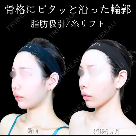 頬・あご下脂肪吸引 /糸リフト/ジョールファット/エラボトックス 180日後 メイン用