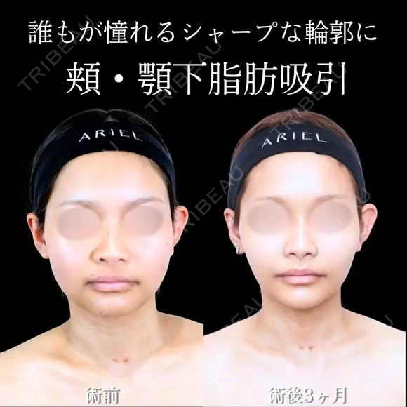 頬・顎下脂肪吸引/ジョールファット/糸リフト 90日後 メイン用