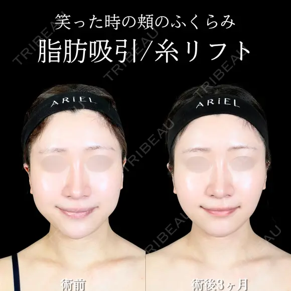 頬・顎下脂肪吸引/糸リフト/バッカルファット/ジョールファット/エラボトックス 90日後 メイン用