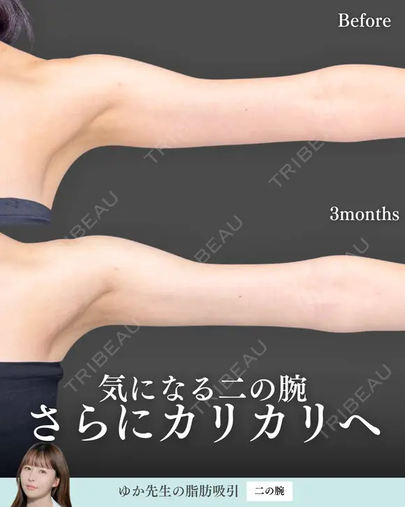 脂肪吸引(二の腕) 180日後 メイン用